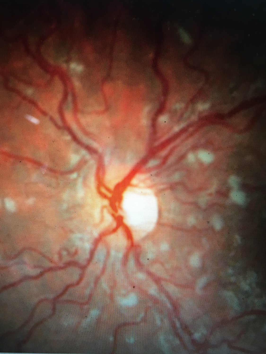 Ophthalmology Flashcards Memorang